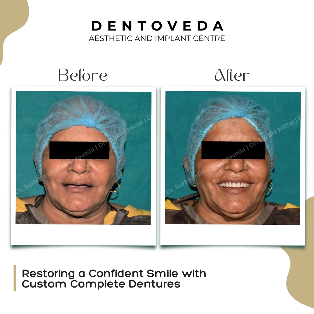 Before and after: Complete Denture Smile
