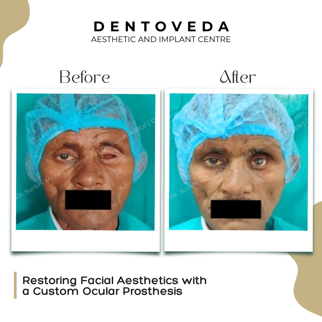 Before and after: Custom Ocular Prosthesis
