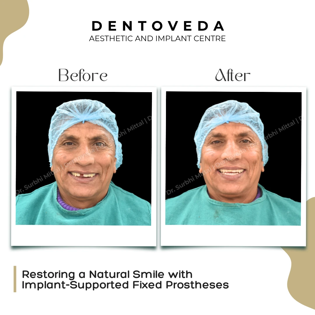 Before and after: Implant Supported Fixed Prosthesis