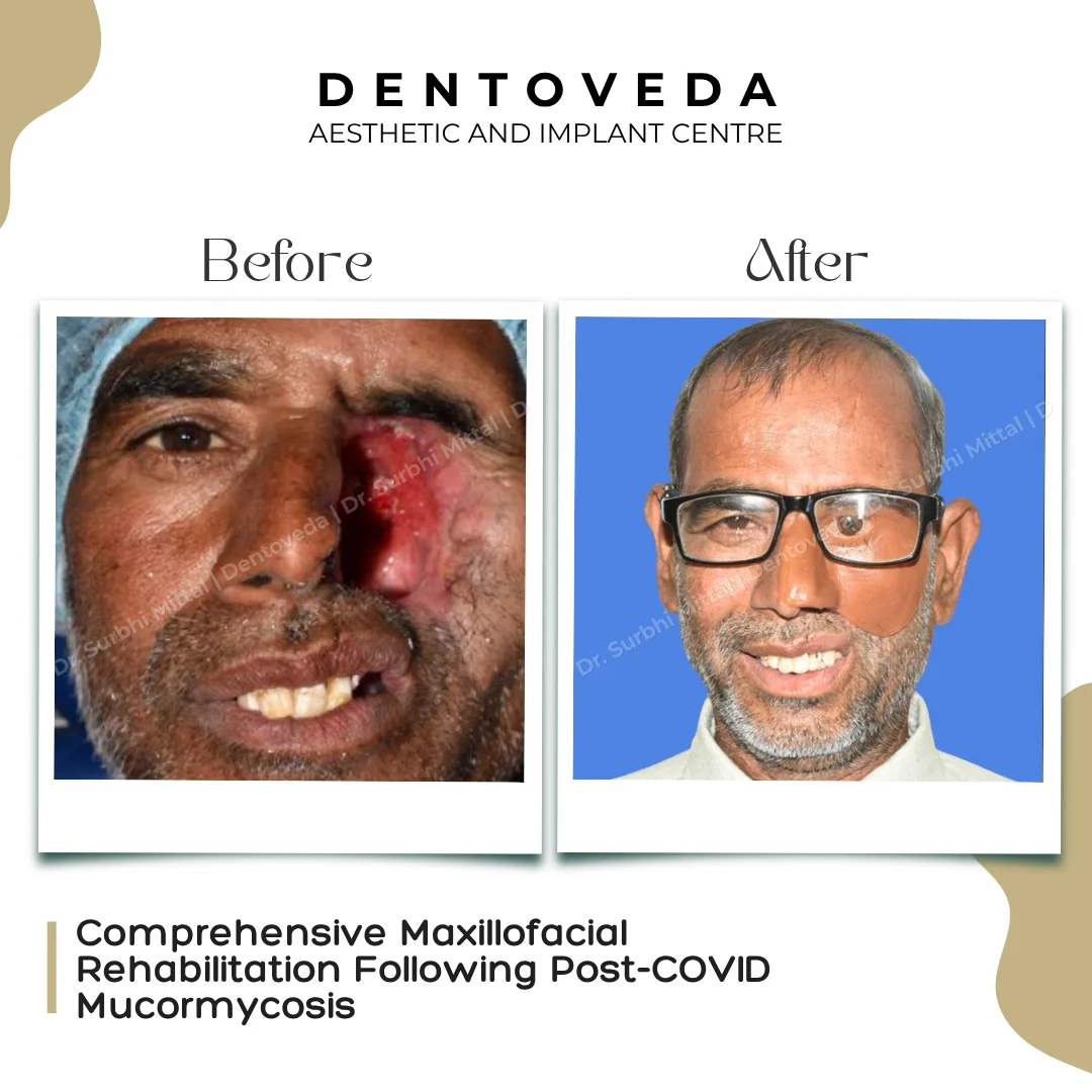 Before and after: Mucormycosis Rehabilitation