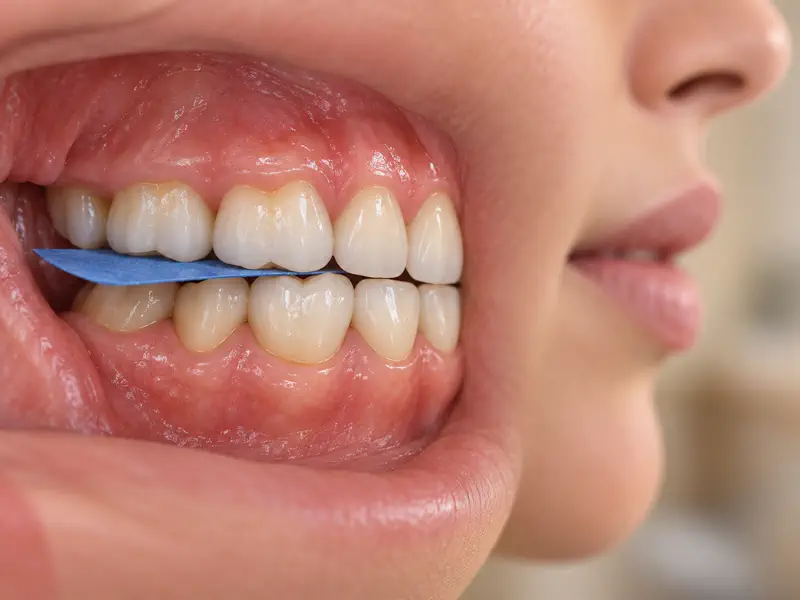 Bite registration strip placed between upper and lower teeth during dental evaluation